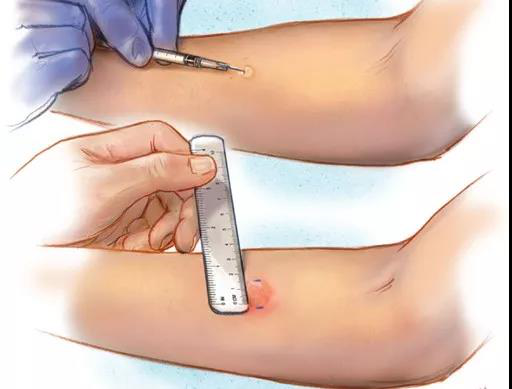 (51u) ppd皮试液于前臂屈侧中上1/3处(避开瘢痕及硬结)进行皮内注射